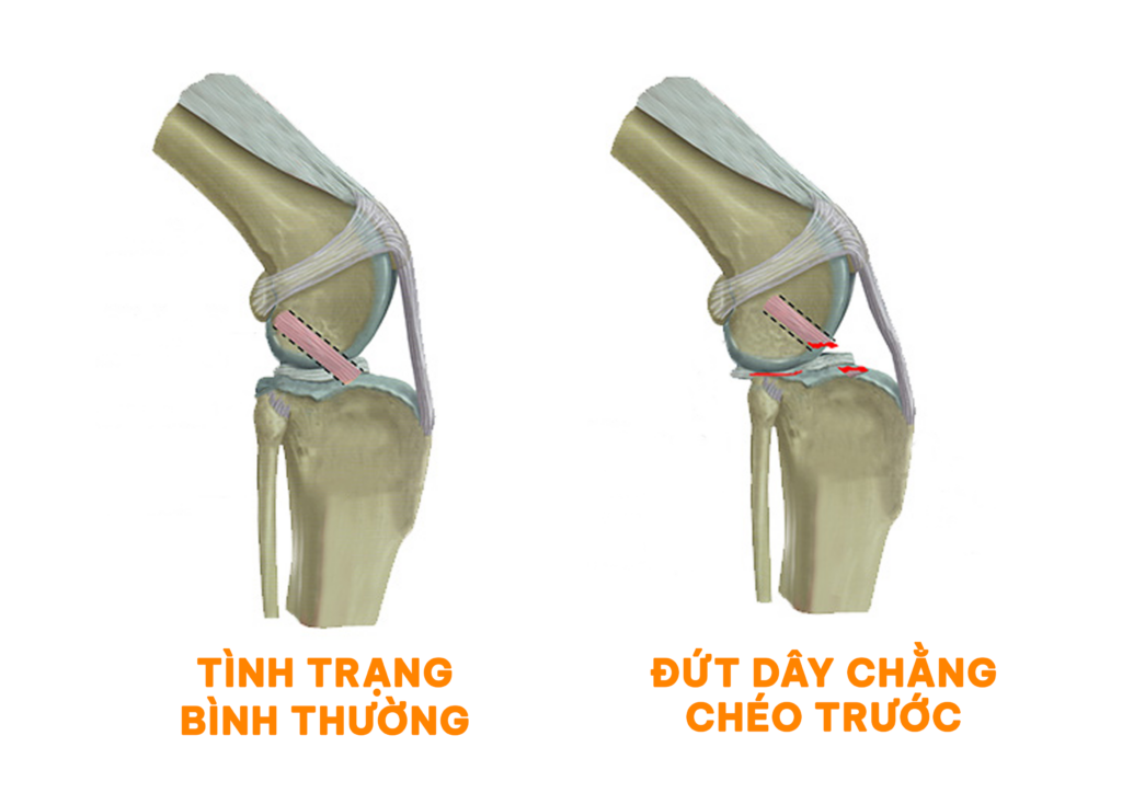 chó bị đứt dây chằng chéo trước